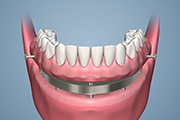 Lower Implant Bar and locking Mechanism